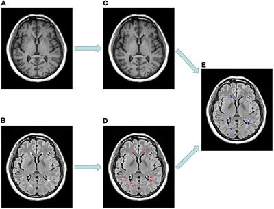 The Application of Diffusion Kurtosis Imaging on the Heterogeneous White Matter in Relapsing-Remitting Multiple Sclerosis